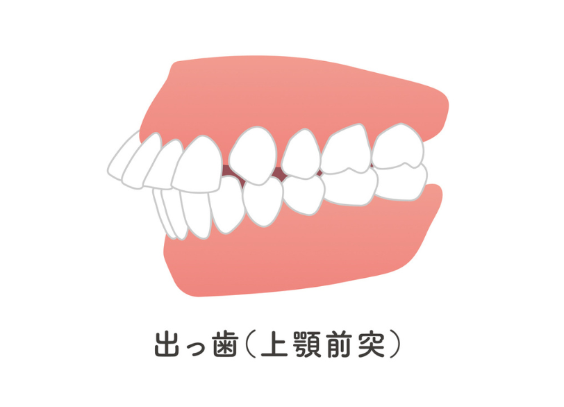 上顎前突|ABC歯科