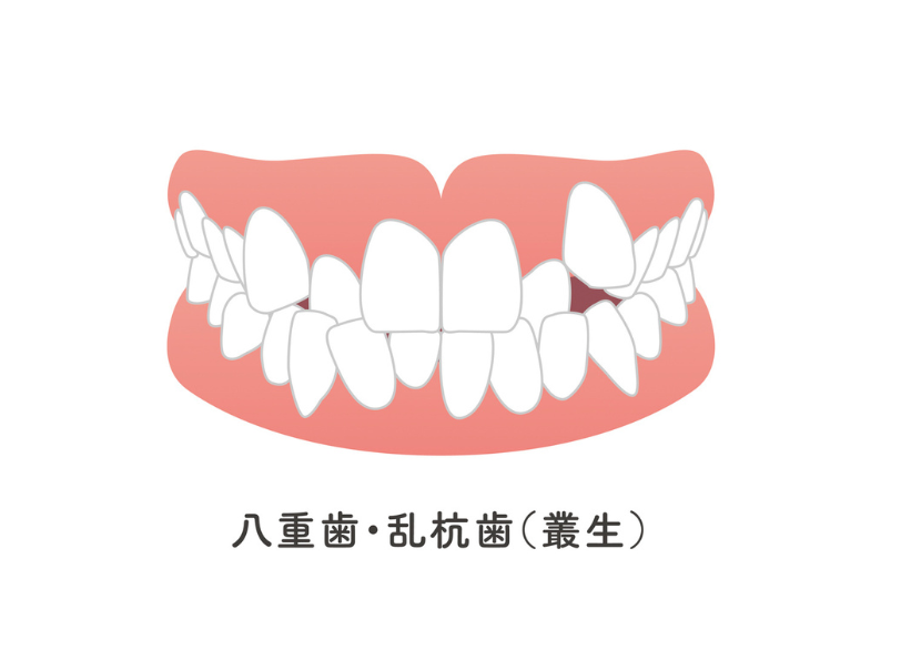 叢生|ABC歯科