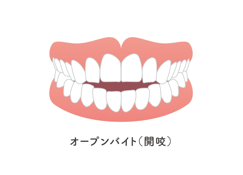 開咬|ABC歯科