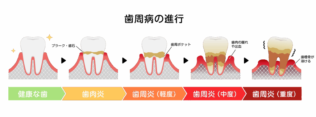 歯周病の進行過程|ABC歯科